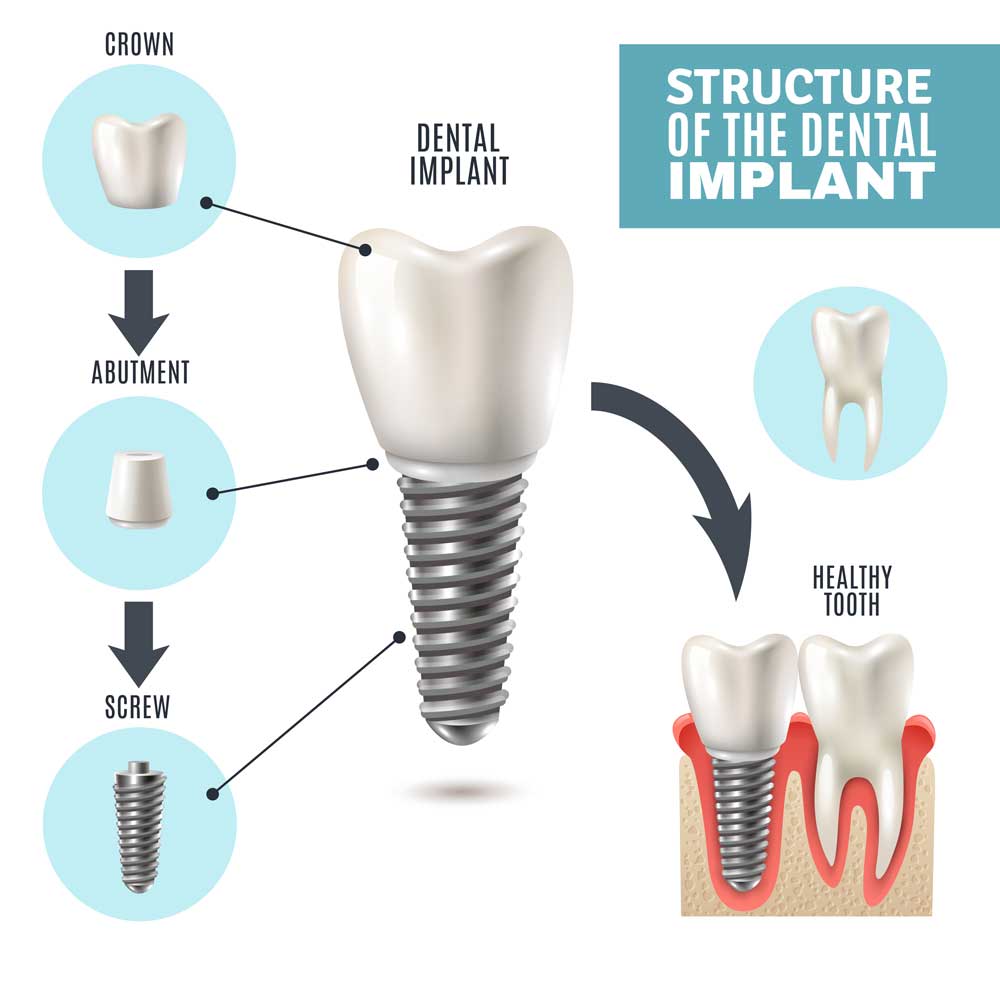 A diagram of dental implants.