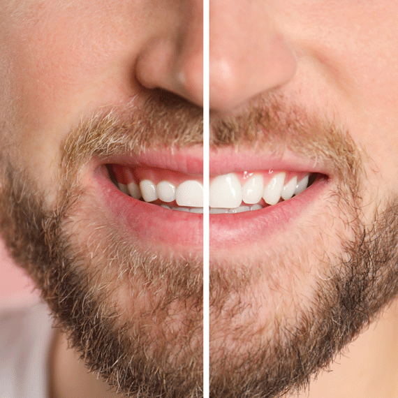 Before-and-after smile showing gum contouring