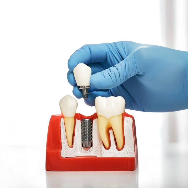Implant Dentistry in Ilderton, ON