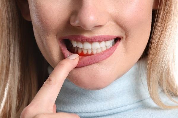 Woman pulling down her lip to show red, inflamed gums